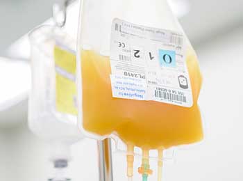 A bag of platelets hangs for a transfusion