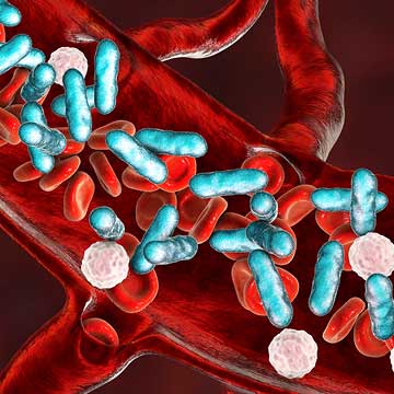 Sepsis, bacteria in blood