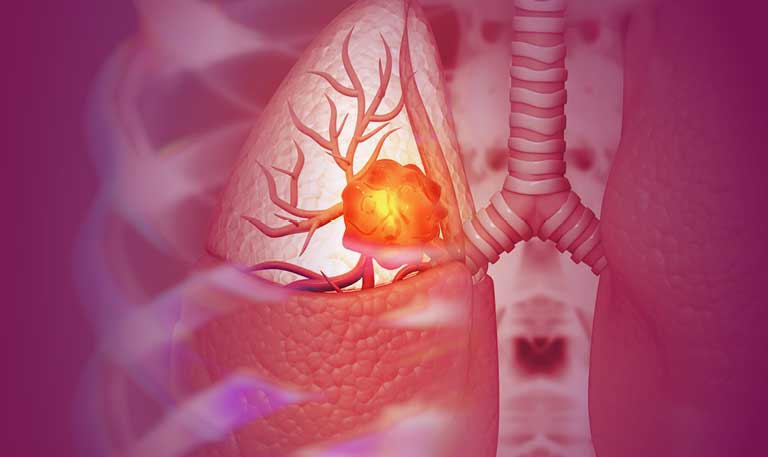 Lung cancer abstract artwork